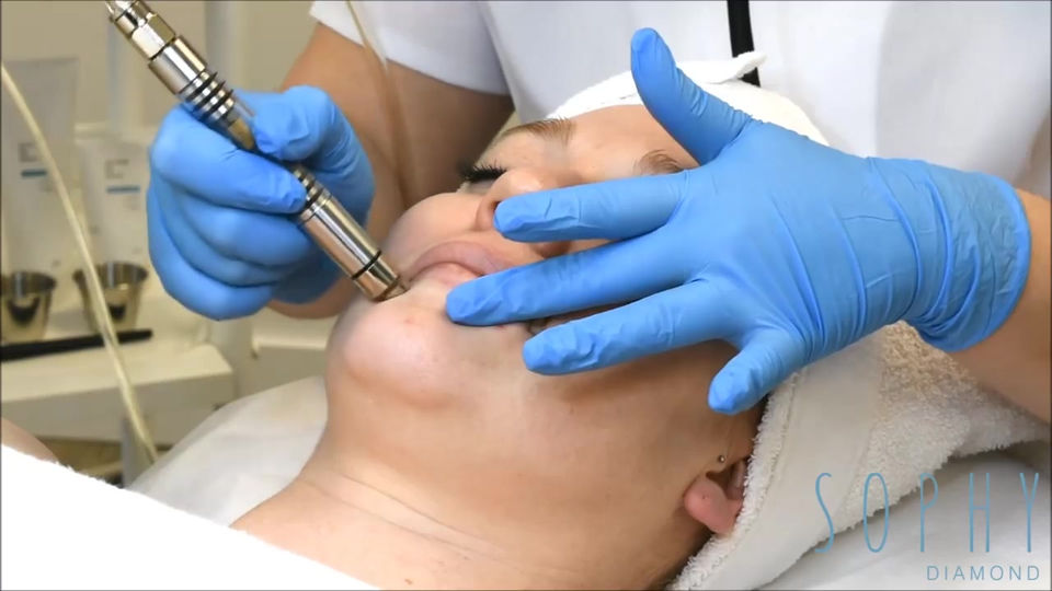 𝗠𝗶𝗰𝗿𝗼𝗱𝗲𝗿𝗺𝗮𝗯𝗿𝗮𝘀𝗶𝗼𝗻